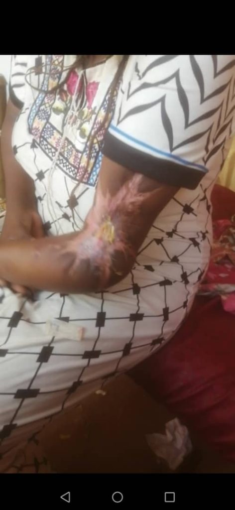 كسر في اليد يحتاج لتدخل جراحي تصحيحي