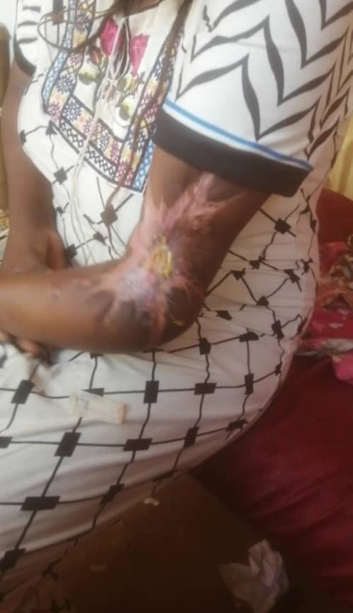 كسر في اليد يحتاج لتدخل جراحي تصحيحي